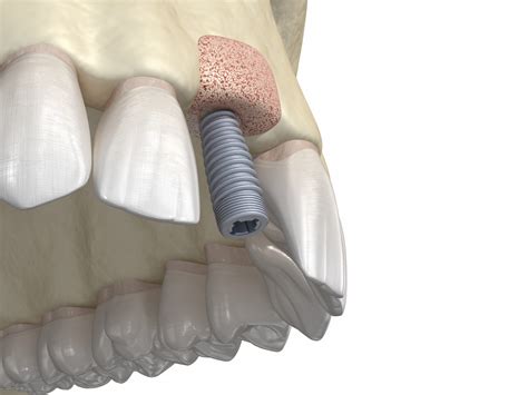  Osseointegration: การสร้างกระดูกใหม่ของ Osmium ในอุตสาหกรรมการแพทย์และทันตกรรม